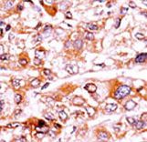 Formalin-fixed and paraffin-embedded human cancer tissue reacted with the primary antibody, which was peroxidase-conjugated to the secondary antibody, followed by AEC staining. This data demonstrates the use of this antibody for immunohistochemistry; clinical relevance has not been evaluated. BC = breast carcinoma; HC = hepatocarcinoma.