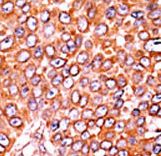 Formalin-fixed and paraffin-embedded human cancer tissue reacted with the primary antibody, which was peroxidase-conjugated to the secondary antibody, followed by AEC staining. This data demonstrates the use of this antibody for immunohistochemistry; clinical relevance has not been evaluated. BC = breast carcinoma; HC = hepatocarcinoma.
