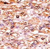 Formalin-fixed and paraffin-embedded human cancer tissue reacted with the primary antibody, which was peroxidase-conjugated to the secondary antibody, followed by AEC staining. This data demonstrates the use of this antibody for immunohistochemistry; clinical relevance has not been evaluated. BC = breast carcinoma; HC = hepatocarcinoma.