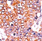 Formalin-fixed and paraffin-embedded human cancer tissue reacted with the primary antibody, which was peroxidase-conjugated to the secondary antibody, followed by AEC staining. This data demonstrates the use of this antibody for immunohistochemistry; clinical relevance has not been evaluated. BC = breast carcinoma; HC = hepatocarcinoma.