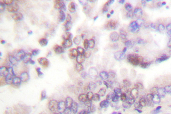 IHC of p15 INK (G113) pAb in paraffin-embedded human lung carcinoma tissue.