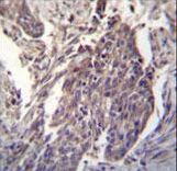 CDKN2B Antibody immunohistochemistry of formalin-fixed and paraffin-embedded human lung carcinoma followed by peroxidase-conjugated secondary antibody and DAB staining.