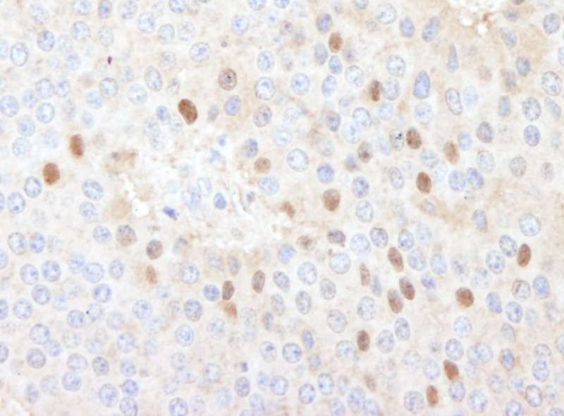 Detection of Human CDT1 by Immunohistochemistry. Sample: FFPE section of human islet cell carcinoma. Antibody: Affinity purified rabbit anti-CDT` used at a dilution of 1:1000 (1 ug/ml).