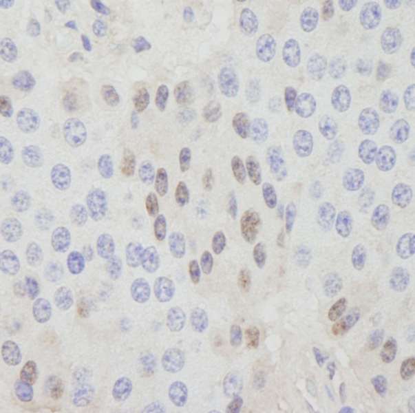 Detection of Human CDT1 by Immunohistochemistry. Sample: FFPE section of human pancreatic islet cell tumor. Antibody: Affinity purified rabbit anti-CDT1 used at a dilution of 1:250.