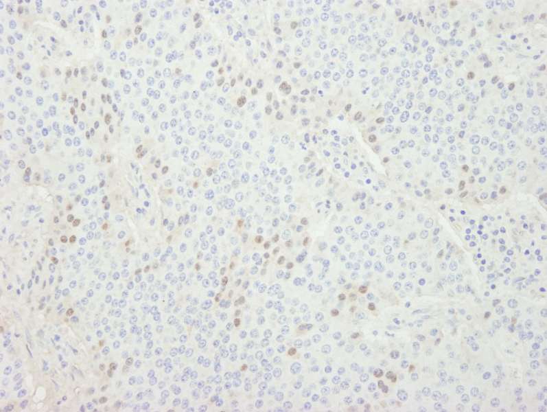 Detection of Human CDT1 by Immunohistochemistry. Sample: FFPE section of human pancreatic islet cell tumor. Antibody: Affinity purified rabbit anti-CDT1 used at a dilution of 1:250.