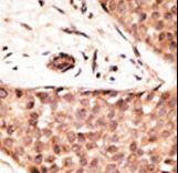 Formalin-fixed and paraffin-embedded human cancer tissue reacted with the primary antibody, which was peroxidase-conjugated to the secondary antibody, followed by AEC staining. This data demonstrates the use of this antibody for immunohistochemistry; clinical relevance has not been evaluated. BC = breast carcinoma; HC = hepatocarcinoma.