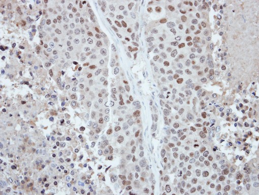 IHC of paraffin-embedded BT474 xenograft, using CDYL antibody at 1:250 dilution.