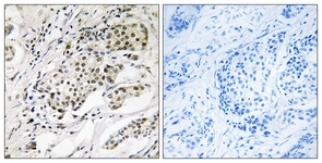 IHC of paraffin-embedded human breast carcinoma, using CDYL2 Antibody. The picture on the right is treated with the synthesized peptide.