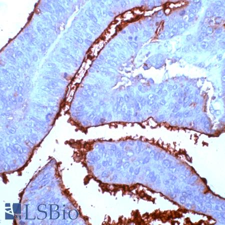 Immunohistochemistry of Human Colon Carcinoma stained with anti-CEA/CD66e antibody