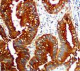 IHC of CEA on FFPE Colon Adenocarcinoma tissue.