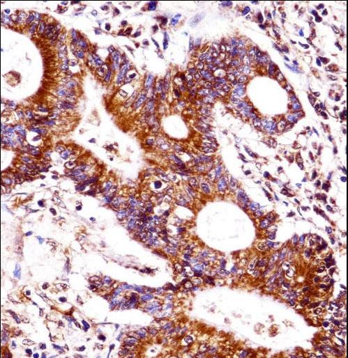 CEACAM7 Antibody immunohistochemistry of formalin-fixed and paraffin-embedded human colon carcinoma followed by peroxidase-conjugated secondary antibody and DAB staining.