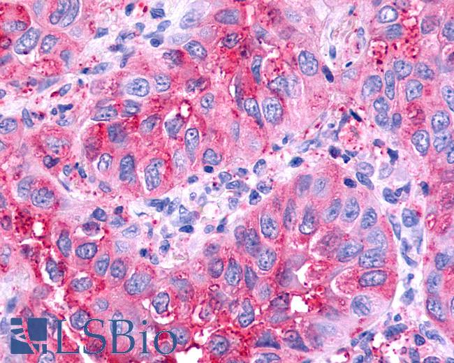 Anti-CELSR1 antibody IHC of human Lung, Non-Small Cell Carcinoma. Immunohistochemistry of formalin-fixed, paraffin-embedded tissue after heat-induced antigen retrieval.