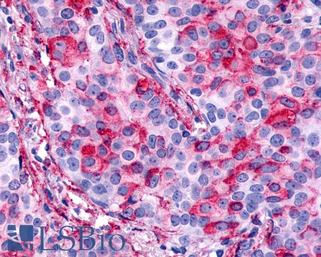 Anti-CELSR1 antibody IHC of human Breast, Carcinoma. Immunohistochemistry of formalin-fixed, paraffin-embedded tissue after heat-induced antigen retrieval.