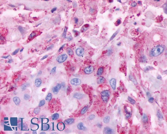 Anti-CELSR2 antibody IHC of human Colon, Carcinoma. Immunohistochemistry of formalin-fixed, paraffin-embedded tissue after heat-induced antigen retrieval.