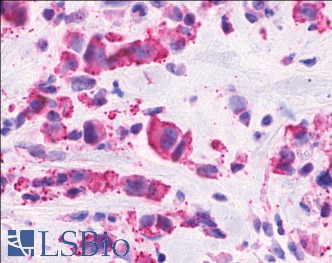 Anti-CELSR2 antibody IHC of human Breast, Carcinoma. Immunohistochemistry of formalin-fixed, paraffin-embedded tissue after heat-induced antigen retrieval.