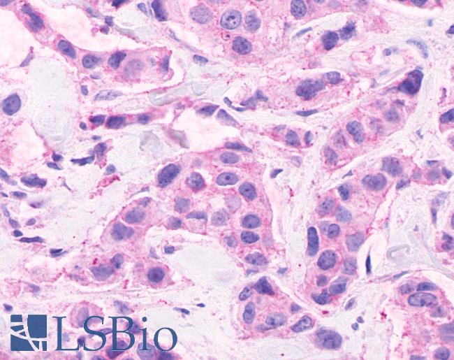Anti-CELSR2 antibody IHC of human Breast, Carcinoma. Immunohistochemistry of formalin-fixed, paraffin-embedded tissue after heat-induced antigen retrieval.