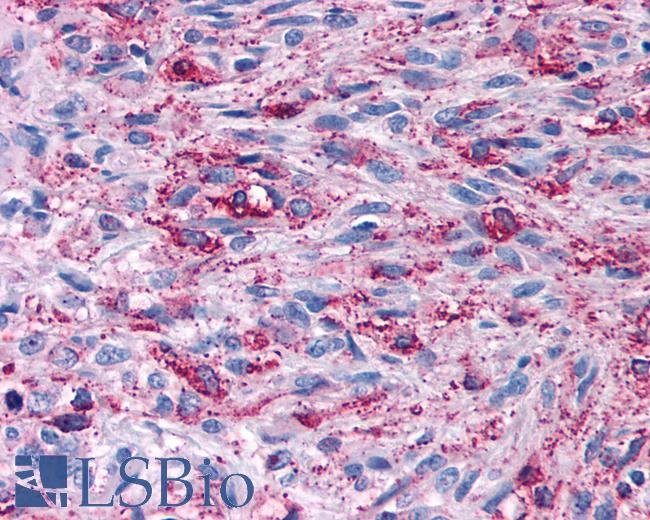 Anti-CELSR2 antibody IHC of human Brain, Glioblastoma. Immunohistochemistry of formalin-fixed, paraffin-embedded tissue after heat-induced antigen retrieval.