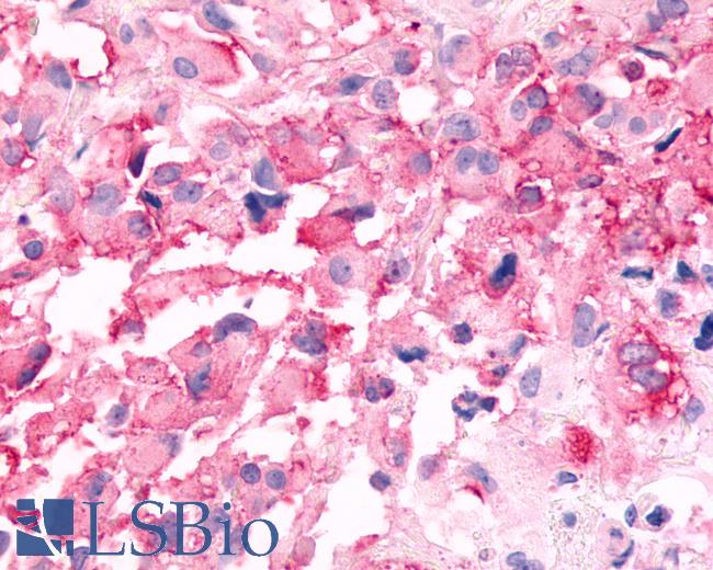Anti-CELSR3 antibody IHC of human Brain, Glioblastoma. Immunohistochemistry of formalin-fixed, paraffin-embedded tissue after heat-induced antigen retrieval.