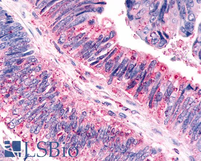 Anti-CELSR3 antibody IHC of human Colon, Carcinoma. Immunohistochemistry of formalin-fixed, paraffin-embedded tissue after heat-induced antigen retrieval.