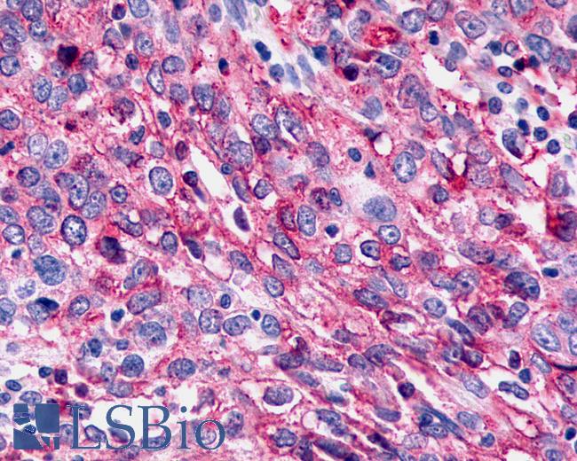 Anti-CELSR3 antibody IHC of human Ovary, Carcinoma. Immunohistochemistry of formalin-fixed, paraffin-embedded tissue after heat-induced antigen retrieval.