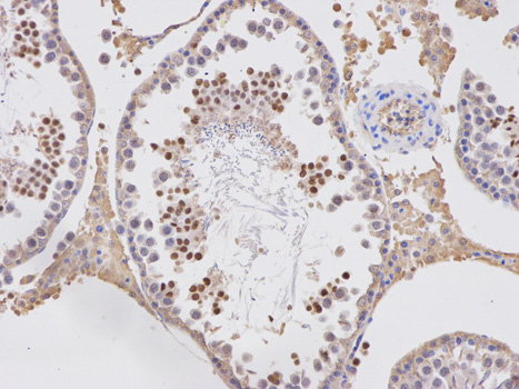 Immunohistochemistry of paraffin-embedded human rectal cancer using APOBEC3G antibody at dilution of 1:100 (200x lens).