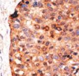 Formalin-fixed and paraffin-embedded human cancer tissue reacted with the primary antibody, which was peroxidase-conjugated to the secondary antibody, followed by DAB staining. This data demonstrates the use of this antibody for immunohistochemistry; clinical relevance has not been evaluated. BC = breast carcinoma; HC = hepatocarcinoma.