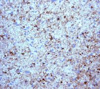 IHC of paraffin-embedded human glioma tissue using anti-BM88 antibody (LS-C105694).