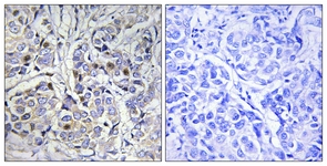 IHC of paraffin-embedded human breast carcinoma tissue, using Centromeric Protein A (Ab-7) Antibody. The picture on the right is treated with the synthesized peptide.