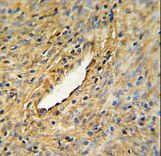 CEP63 Antibody IHC of formalin-fixed and paraffin-embedded prostate carcinoma followed by peroxidase-conjugated secondary antibody and DAB staining.