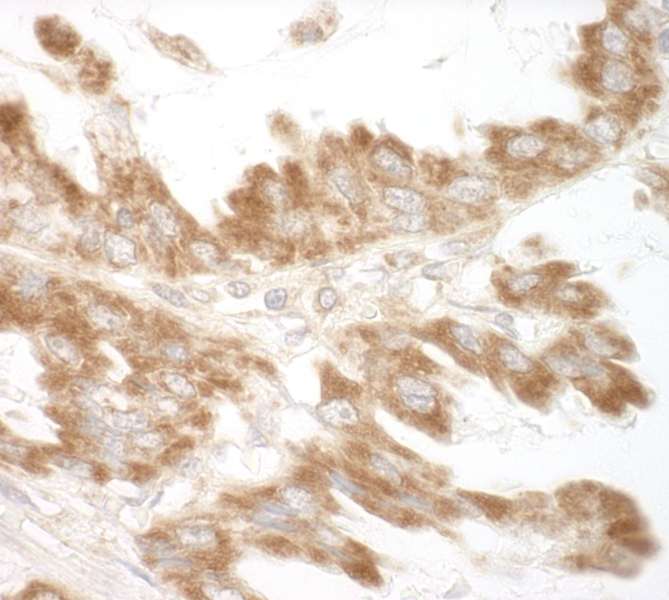 Detection of Human CEP68 by Immunohistochemistry. Sample: FFPE section of human lung carcinoma. Antibody: Affinity purified rabbit anti-CEP68 used at a dilution of 1:1000 (1 ug/ml).