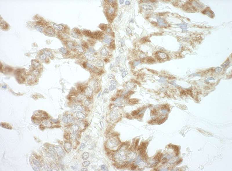 Detection of Human CEP68 by Immunohistochemistry. Sample: FFPE section of human lung carcinoma. Antibody: Affinity purified rabbit anti-CEP68 used at a dilution of 1:250.