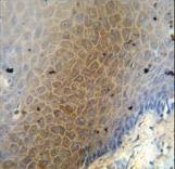 CEP70 antibody immunohistochemistry of formalin-fixed and paraffin-embedded human skin carcinoma followed by peroxidase-conjugated secondary antibody and DAB staining.