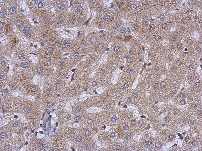 IHC of paraffin-embedded Hepatoma, using CERCAM antibody at 1:500 dilution.