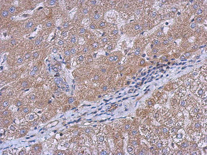 IHC of paraffin-embedded Hepatoma, using CERCAM antibody at 1:500 dilution.