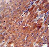 CES2 antibody immunohistochemistry of formalin-fixed and paraffin-embedded human hepatocarcinoma followed by peroxidase-conjugated secondary antibody and DAB staining.