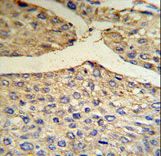 BF Antibody (RB18685) IHC of formalin-fixed and paraffin-embedded human hepatocarcinoma tissue followed by peroxidase-conjugated secondary antibody and DAB staining.