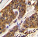 CFD Antibody immunohistochemistry of formalin-fixed and paraffin-embedded human bladder carcinoma followed by peroxidase-conjugated secondary antibody and DAB staining.