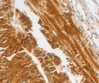 Immunohistochemistry of paraffin-embedded human liver cancer tissue using CFHR1antibody.