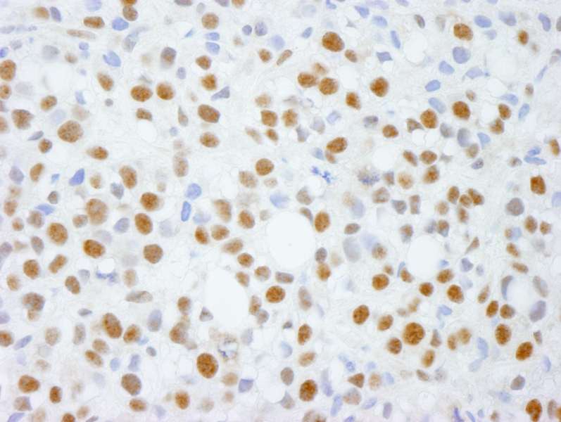 Detection of Human ADNP by Immunohistochemistry. Sample: FFPE section of human metastatic bone marrow. Antibody: Affinity purified rabbit anti-ADNP used at a dilution of 1:250.