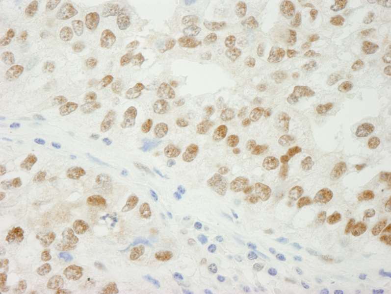 Detection of Human ADNP by Immunohistochemistry. Sample: FFPE section of human breast adenocarcinoma. Antibody: Affinity purified rabbit anti-ADNP used at a dilution of 1:250.