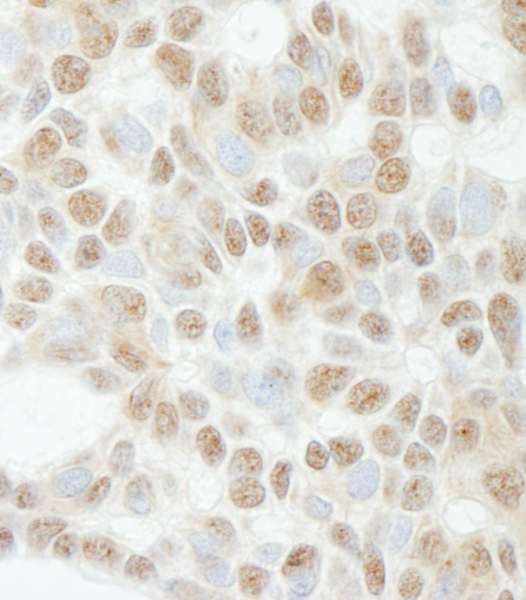 Detection of Human ADNP by Immunohistochemistry. Sample: FFPE section of human skin basal cell carcinoma. Antibody: Affinity purified rabbit anti-ADNP used at a dilution of 1:1000 (1 ug/ml). Detection: DAB.