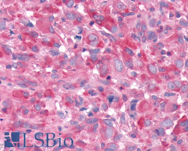 Anti-ADORA1 / Adenosine A1 Receptor antibody IHC of human Brain, Glioblastoma. Immunohistochemistry of formalin-fixed, paraffin-embedded tissue after heat-induced antigen retrieval.