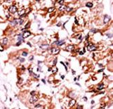 Formalin-fixed and paraffin-embedded human cancer tissue reacted with the primary antibody, which was peroxidase-conjugated to the secondary antibody, followed by AEC staining. This data demonstrates the use of this antibody for immunohistochemistry; clinical relevance has not been evaluated. BC = breast carcinoma; HC = hepatocarcinoma.
