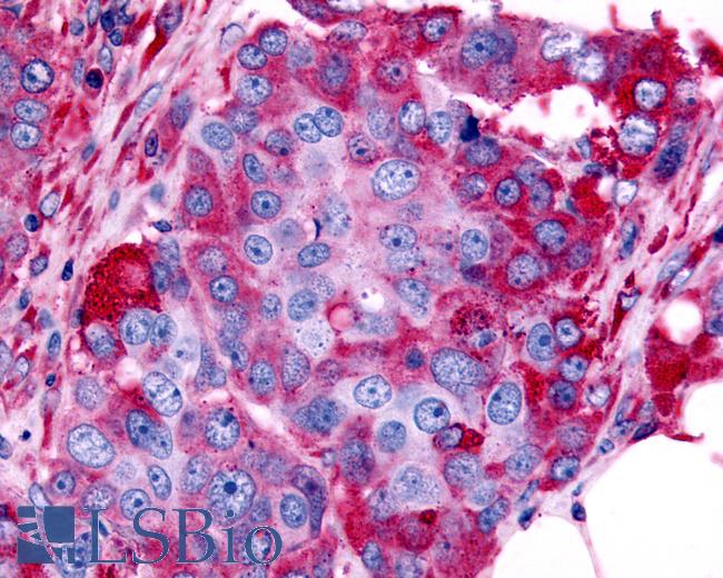 Anti-ADRA1B antibody IHC of human Ovary, Carcinoma. Immunohistochemistry of formalin-fixed, paraffin-embedded tissue after heat-induced antigen retrieval.