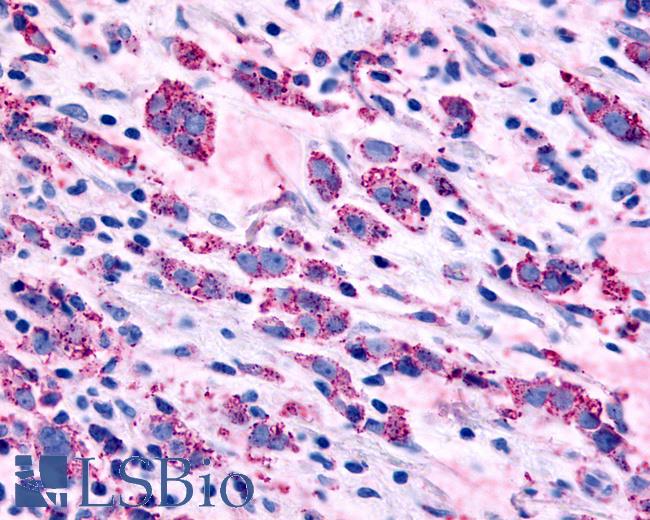 Anti-ADRA1B antibody IHC of human Breast, Carcinoma. Immunohistochemistry of formalin-fixed, paraffin-embedded tissue after heat-induced antigen retrieval.