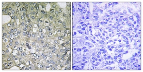 IHC of paraffin-embedded human breast carcinoma tissue, using ADRA1D Antibody. The sample on the right was incubated with synthetic peptide.