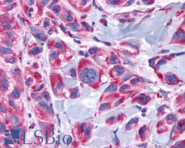 Anti-ADRA1D antibody IHC of human Skin, Melanoma. Immunohistochemistry of formalin-fixed, paraffin-embedded tissue after heat-induced antigen retrieval.