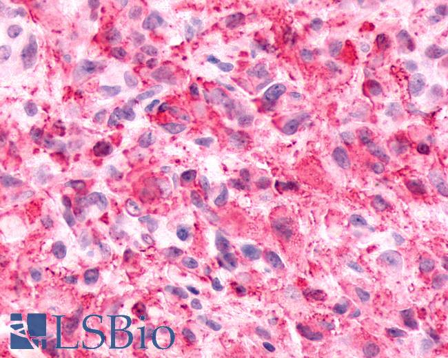 Anti-ADRA2C antibody IHC of human Brain, Glioblastoma. Immunohistochemistry of formalin-fixed, paraffin-embedded tissue after heat-induced antigen retrieval.