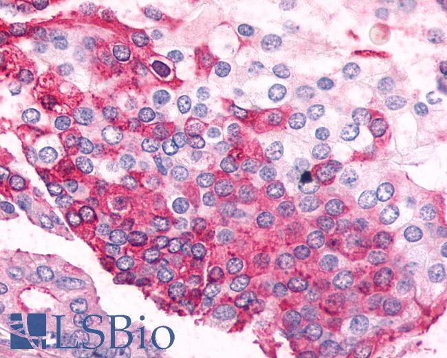 Anti-ADRA2C antibody IHC of human Prostate, Carcinoma. Immunohistochemistry of formalin-fixed, paraffin-embedded tissue after heat-induced antigen retrieval.
