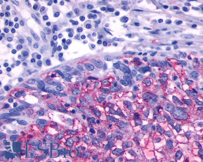 Anti-ADRB3 antibody IHC of human Ovary, Carcinoma. Immunohistochemistry of formalin-fixed, paraffin-embedded tissue after heat-induced antigen retrieval.